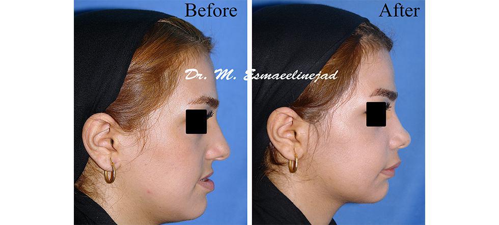 Orthognathic Surgery